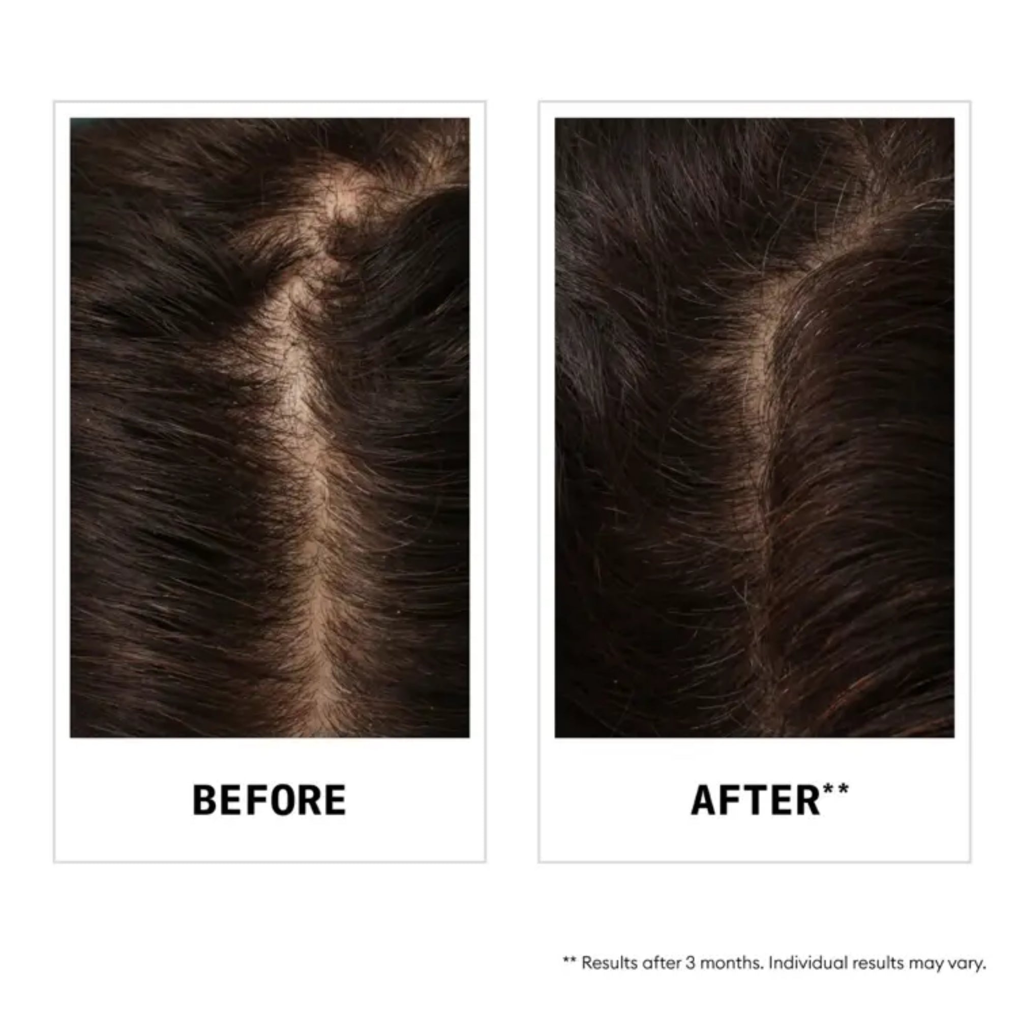 Nioxin Shampoo Anti-Hair Loss Defensa Anticaída  | Fortalece el Cabello desde la Raíz